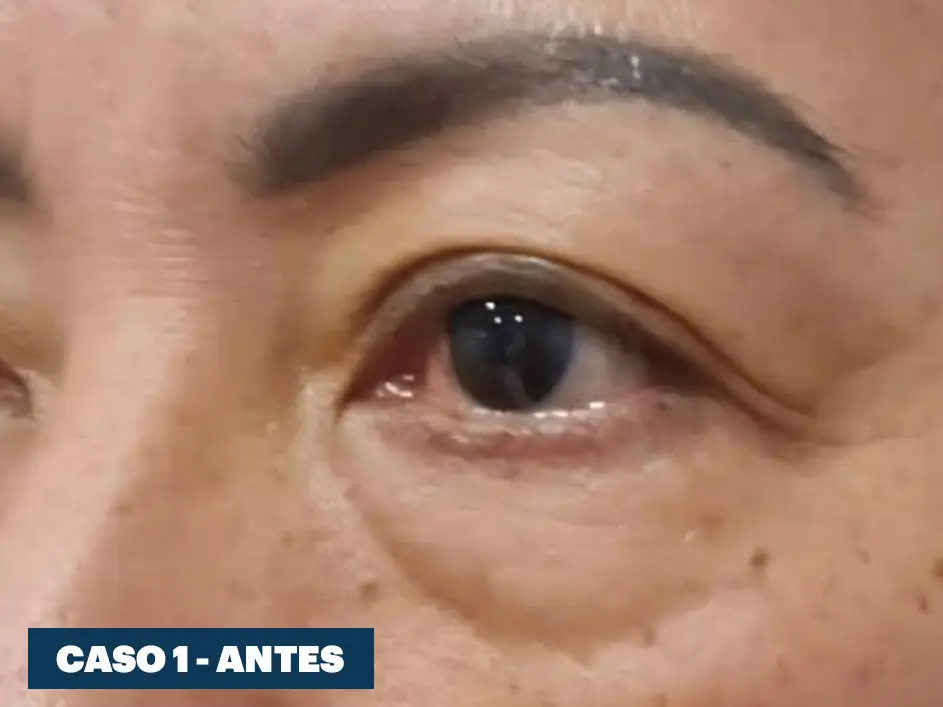 Casos web drdq blefaroplastia 1. 1