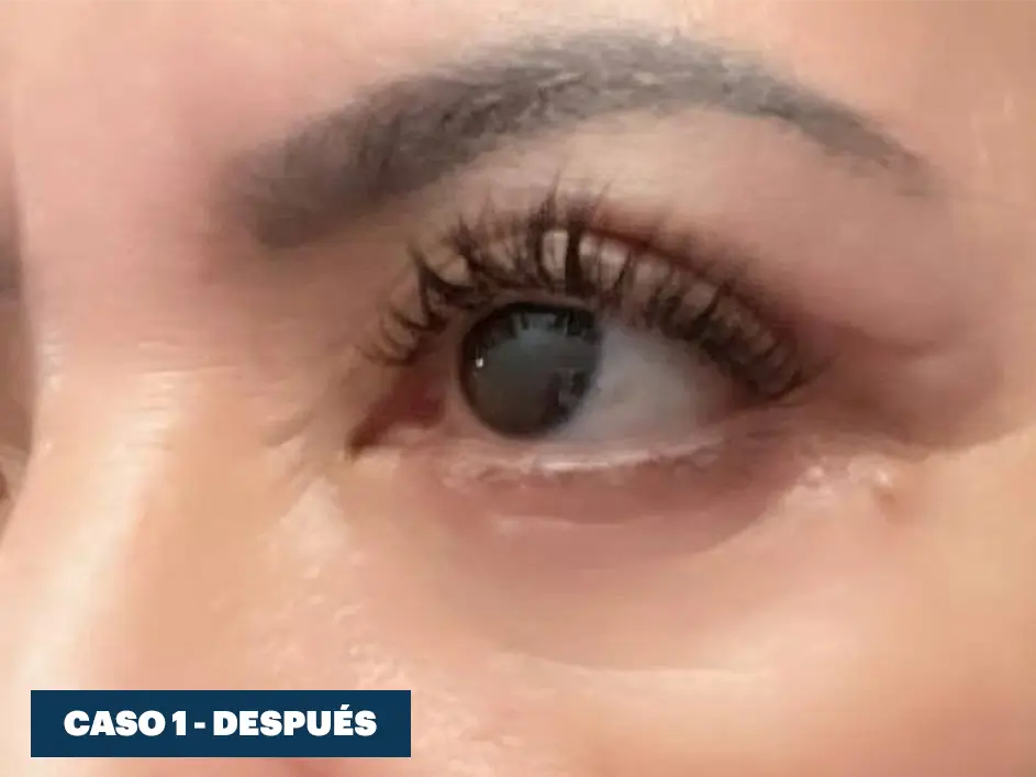 Casos web drdq blefaroplastia 1. 2