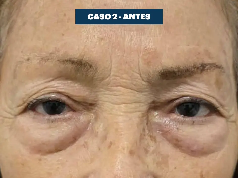 Casos web drdq blefaroplastia 2. 1