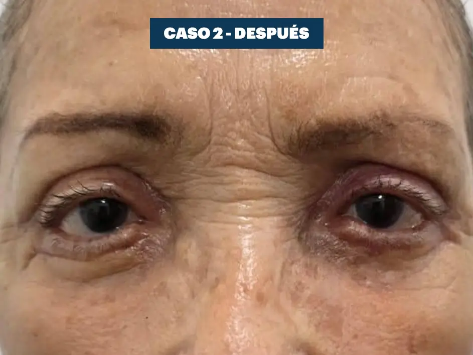 Casos web drdq blefaroplastia 2. 2