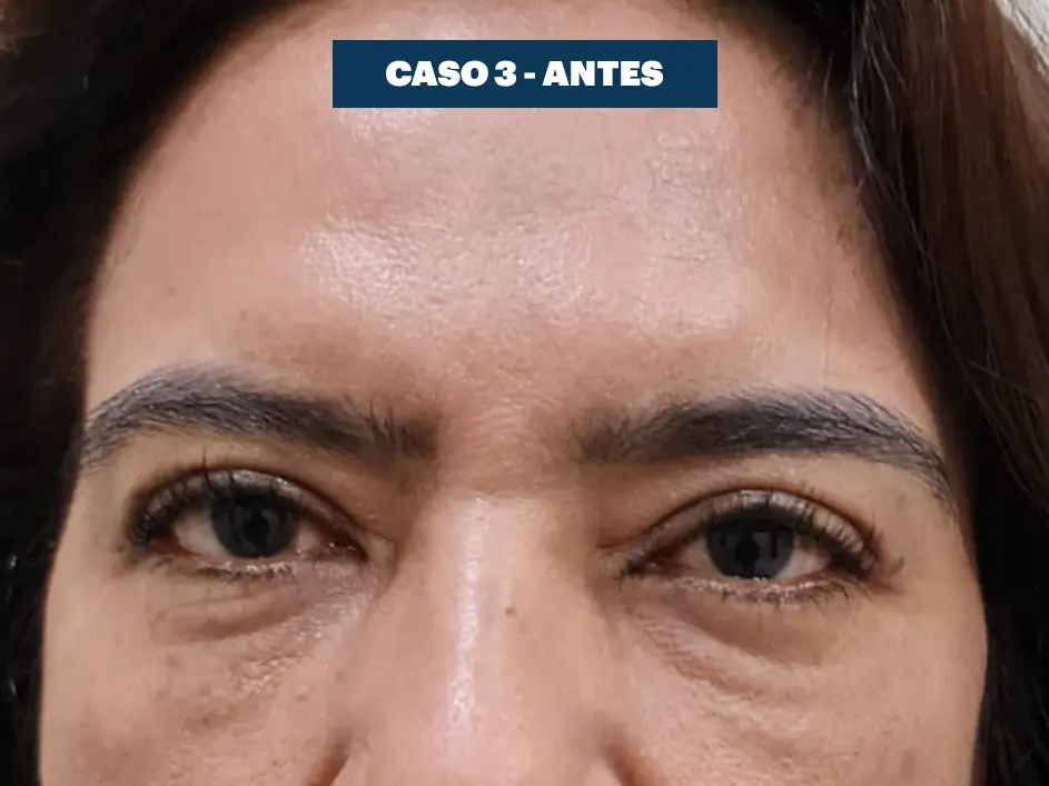 Casos web drdq blefaroplastia 3. 1