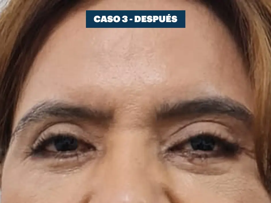 Casos web drdq blefaroplastia 3. 2