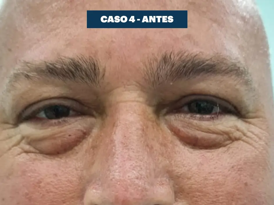 Casos web drdq blefaroplastia 4. 1