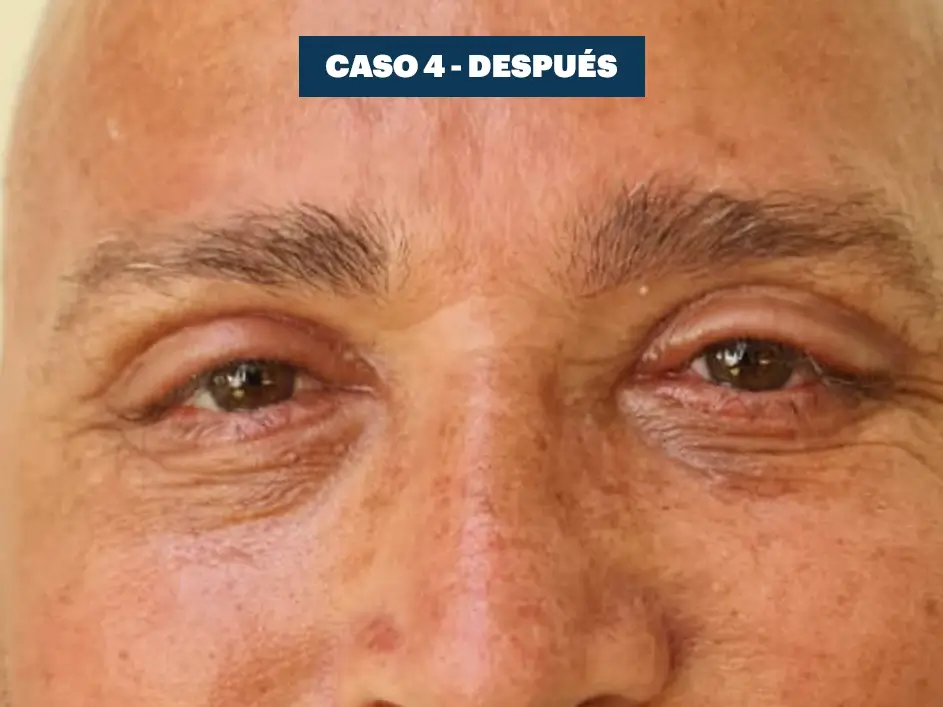 Casos web drdq blefaroplastia 4. 2