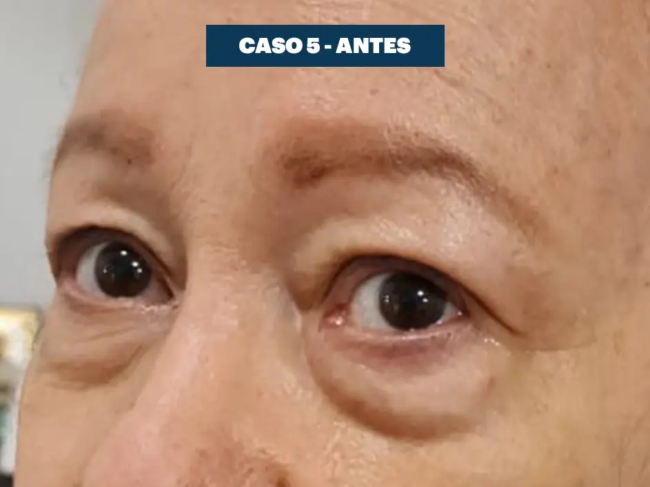 Casos web drdq blefaroplastia 5. 1