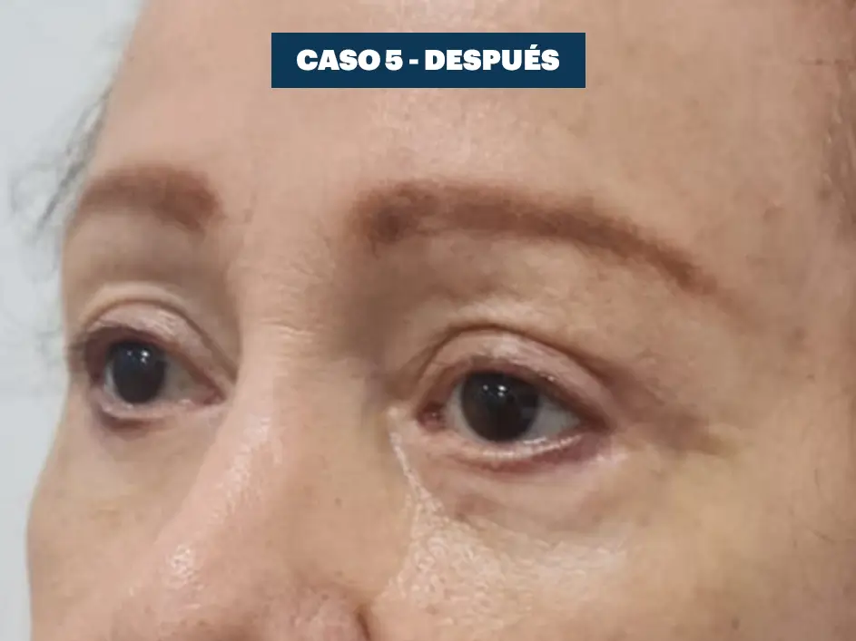 Casos web drdq blefaroplastia 5. 2
