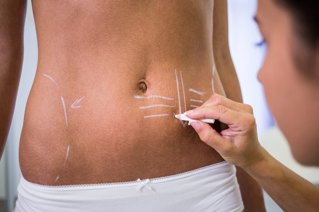 Lipoescultura hd: esculpido 360° para un abdomen perfecto